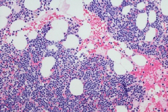 Multiple Myeloma Cells